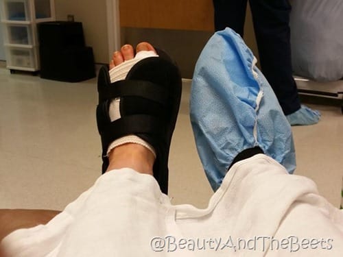 Orlando Foot and Ankle bunionectomy Beauty and the Beets